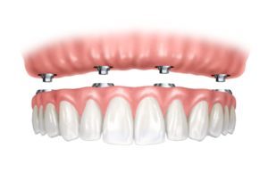 Illustration of how all-on-4 dental implants fit into the gums using dental implant posts.