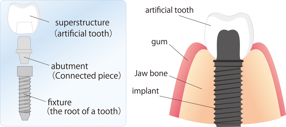 Illustration showing parts of dental implants that are a common procedure at Cigno Family Dental in Greenfield, WI.