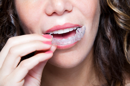 Woman places a tray of invisalign clear braces to help straighten her smile.